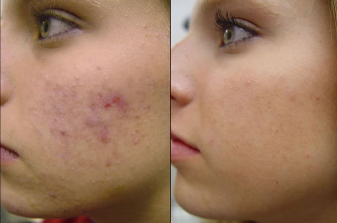 I will remove acne and retouch your photo