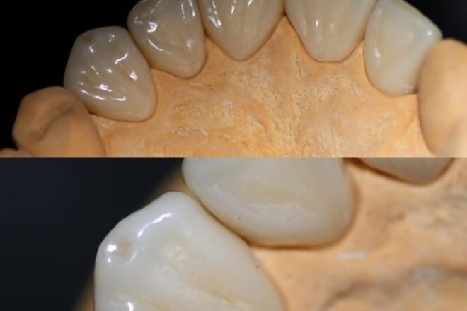 I will design your dental project in exocad inlab