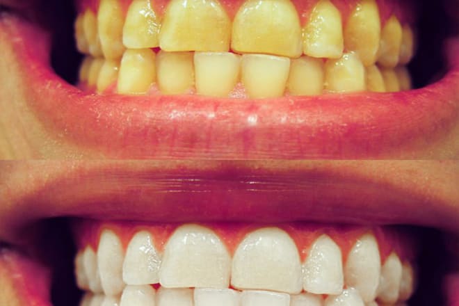 I will make your teeth clean and white