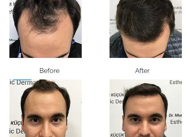 I will provide hair transplant surgery consultation for you